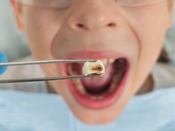 Best Emergency Root Canal Treatment in Daingerfield, TX